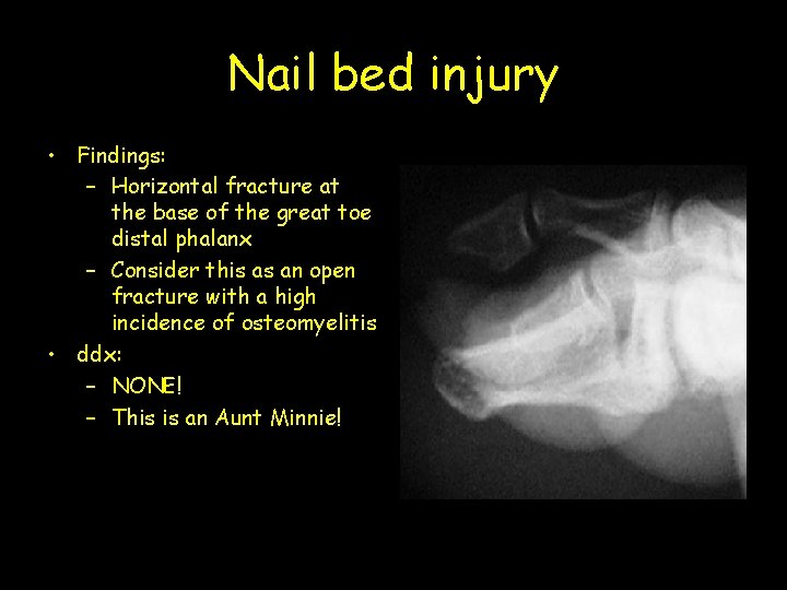 Nail bed injury • Findings: – Horizontal fracture at the base of the great