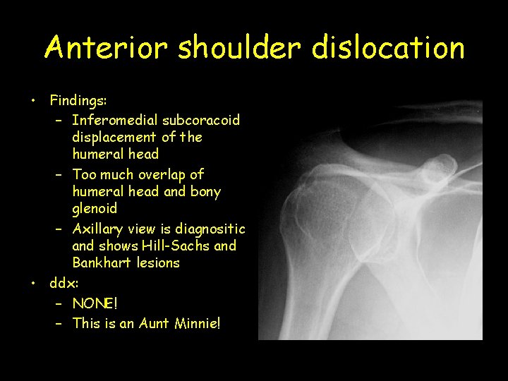 Anterior shoulder dislocation • Findings: – Inferomedial subcoracoid displacement of the humeral head –