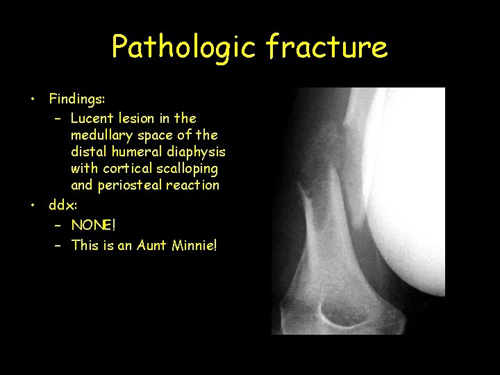 Pathologic fracture • Findings: – Lucent lesion in the medullary space of the distal