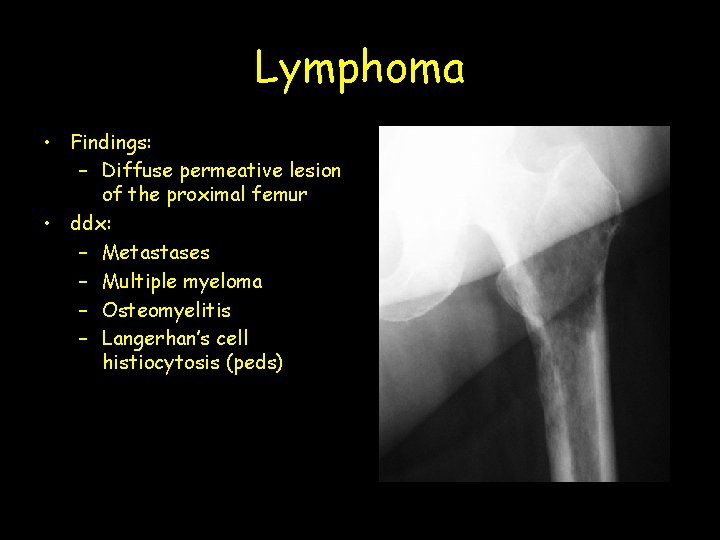 Lymphoma • Findings: – Diffuse permeative lesion of the proximal femur • ddx: –