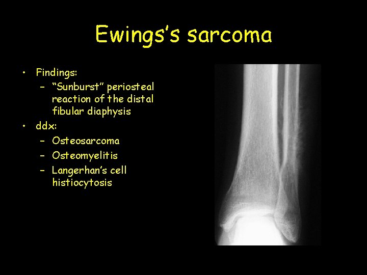 Ewings’s sarcoma • Findings: – “Sunburst” periosteal reaction of the distal fibular diaphysis •