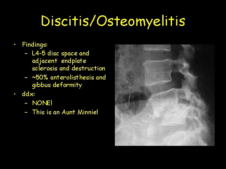 Discitis/Osteomyelitis • Findings: – L 4 -5 disc space and adjacent endplate sclerosis and