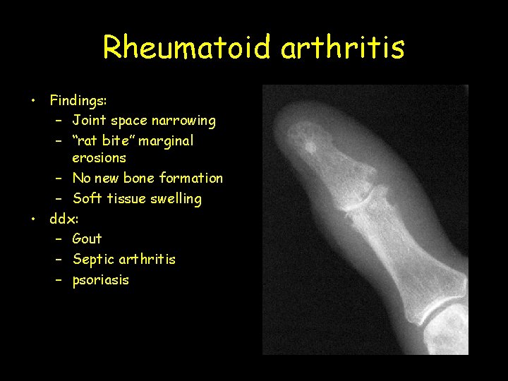 Rheumatoid arthritis • Findings: – Joint space narrowing – “rat bite” marginal erosions –