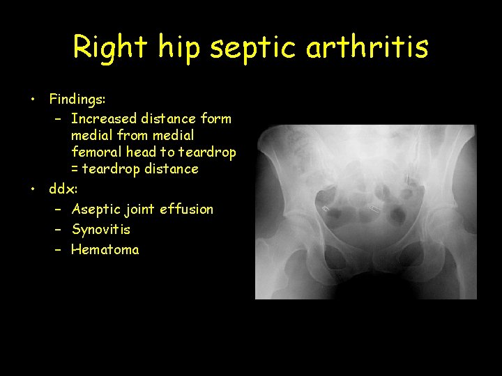 Right hip septic arthritis • Findings: – Increased distance form medial from medial femoral