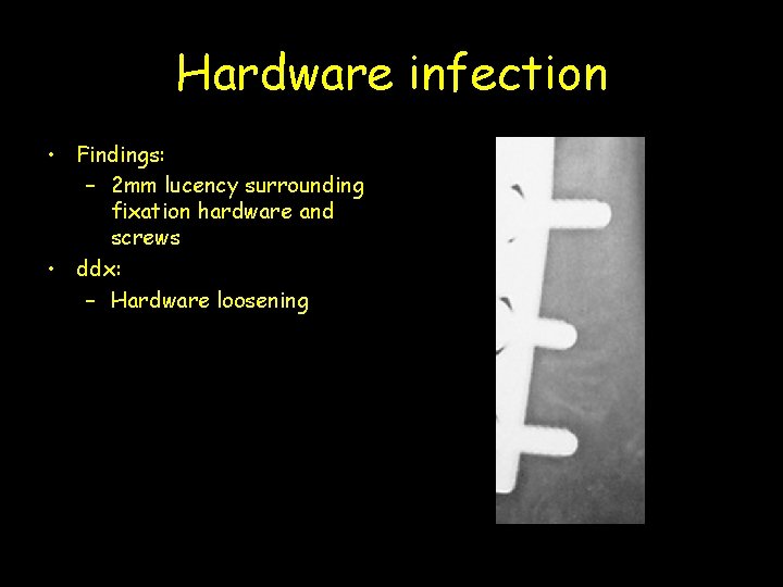 Hardware infection • Findings: – 2 mm lucency surrounding fixation hardware and screws •