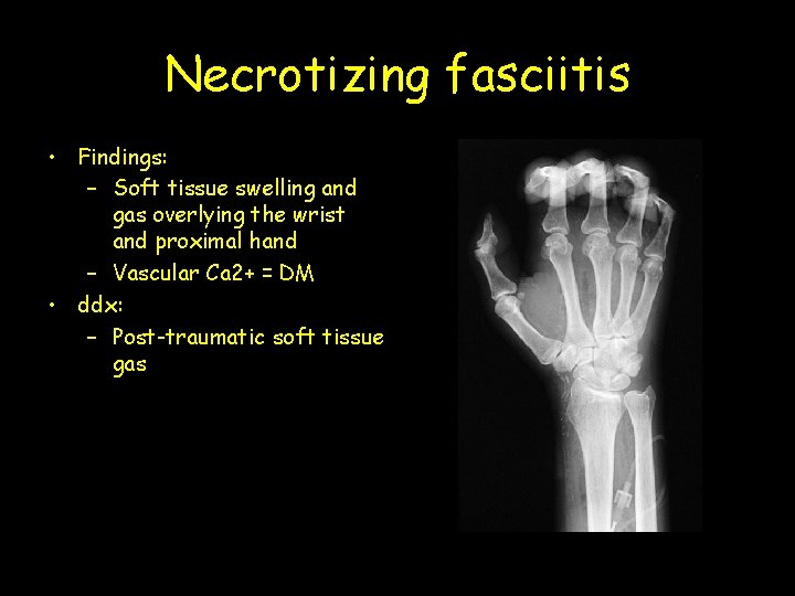 Necrotizing fasciitis • Findings: – Soft tissue swelling and gas overlying the wrist and