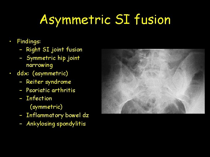 Asymmetric SI fusion • Findings: – Right SI joint fusion – Symmetric hip joint