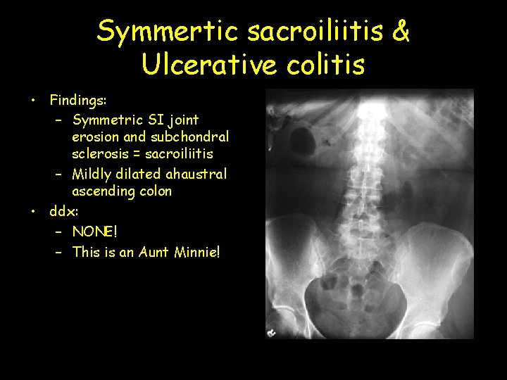 Symmertic sacroiliitis & Ulcerative colitis • Findings: – Symmetric SI joint erosion and subchondral