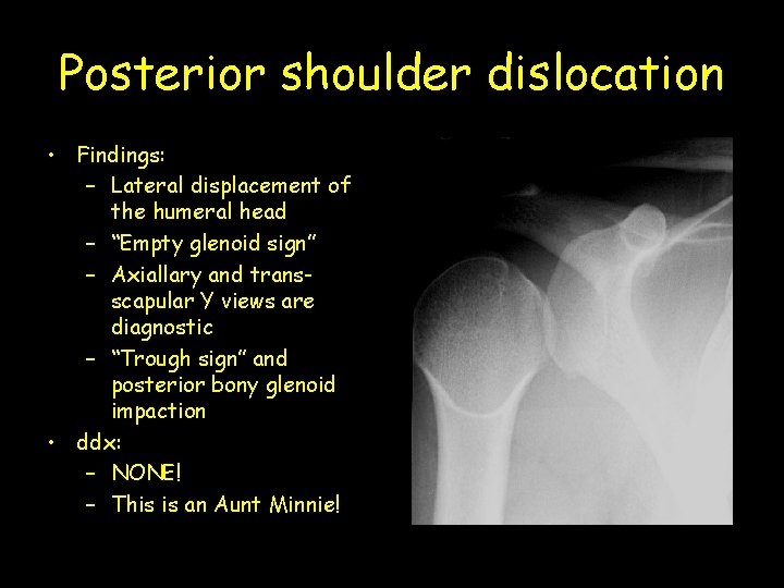 Posterior shoulder dislocation • Findings: – Lateral displacement of the humeral head – “Empty