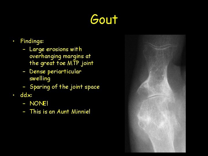 Gout • Findings: – Large erosions with overhanging margins at the great toe MTP