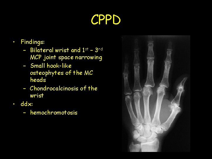 CPPD • Findings: – Bilateral wrist and 1 st – 3 rd MCP joint