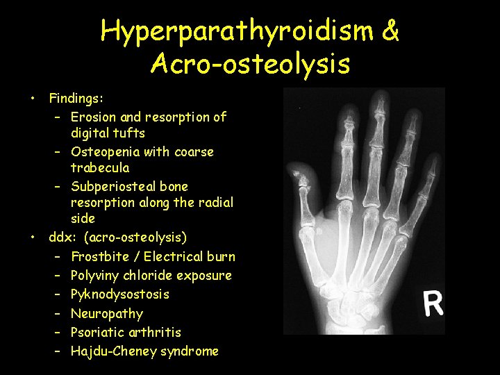 Hyperparathyroidism & Acro-osteolysis • Findings: – Erosion and resorption of digital tufts – Osteopenia