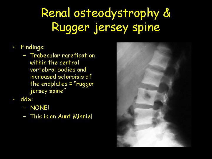 Renal osteodystrophy & Rugger jersey spine • Findings: – Trabecular rarefication within the central