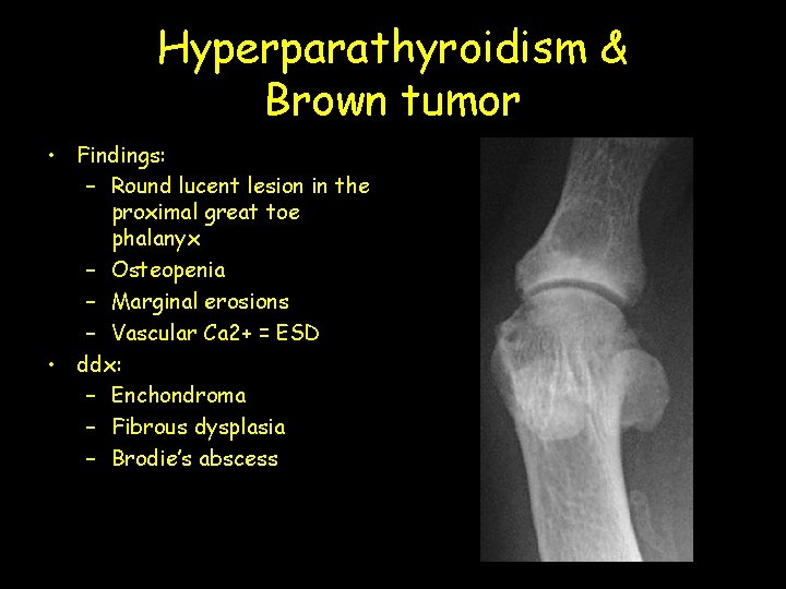 Hyperparathyroidism & Brown tumor • Findings: – Round lucent lesion in the proximal great