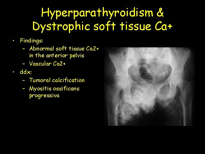 Hyperparathyroidism & Dystrophic soft tissue Ca+ • Findings: – Abnormal soft tissue Ca 2+