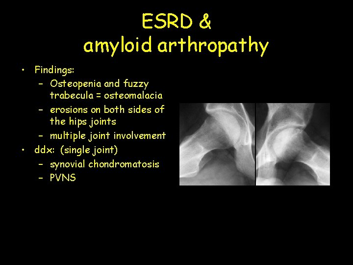 ESRD & amyloid arthropathy • Findings: – Osteopenia and fuzzy trabecula = osteomalacia –