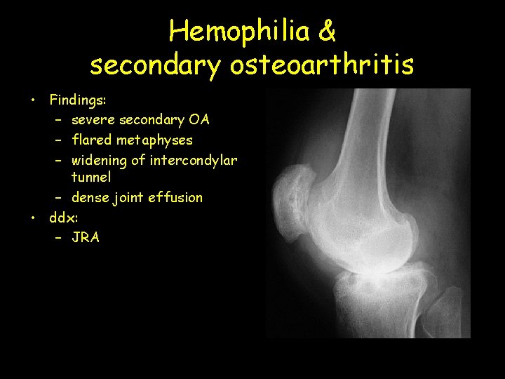 Hemophilia & secondary osteoarthritis • Findings: – severe secondary OA – flared metaphyses –