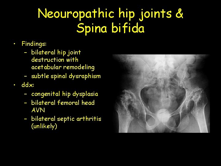 Neouropathic hip joints & Spina bifida • Findings: – bilateral hip joint destruction with