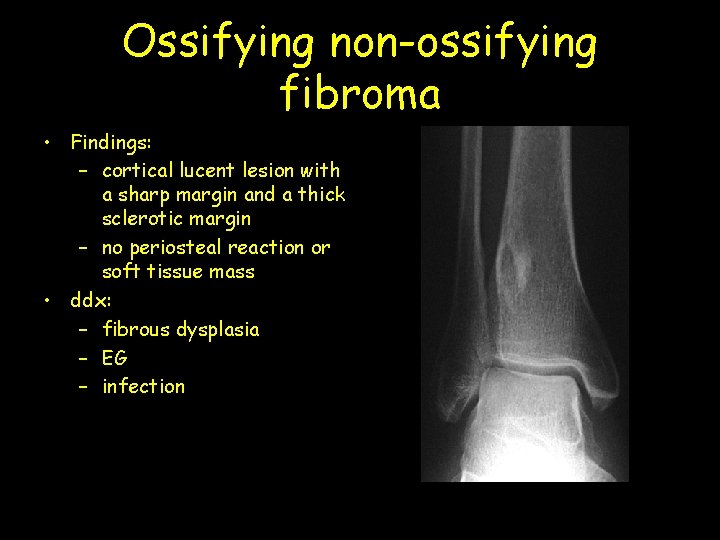 Ossifying non-ossifying fibroma • Findings: – cortical lucent lesion with a sharp margin and