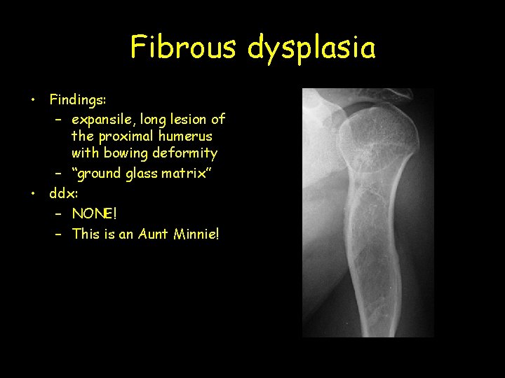 Fibrous dysplasia • Findings: – expansile, long lesion of the proximal humerus with bowing
