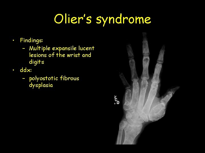 Olier’s syndrome • Findings: – Multiple expansile lucent lesions of the wrist and digits