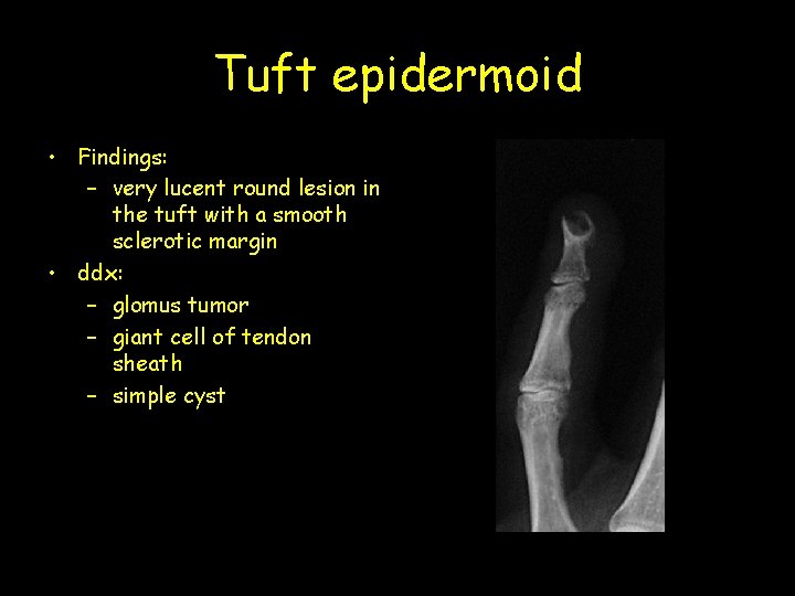 Tuft epidermoid • Findings: – very lucent round lesion in the tuft with a