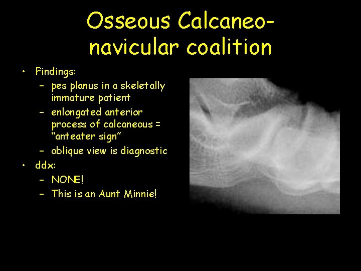 Osseous Calcaneonavicular coalition • Findings: – pes planus in a skeletally immature patient –