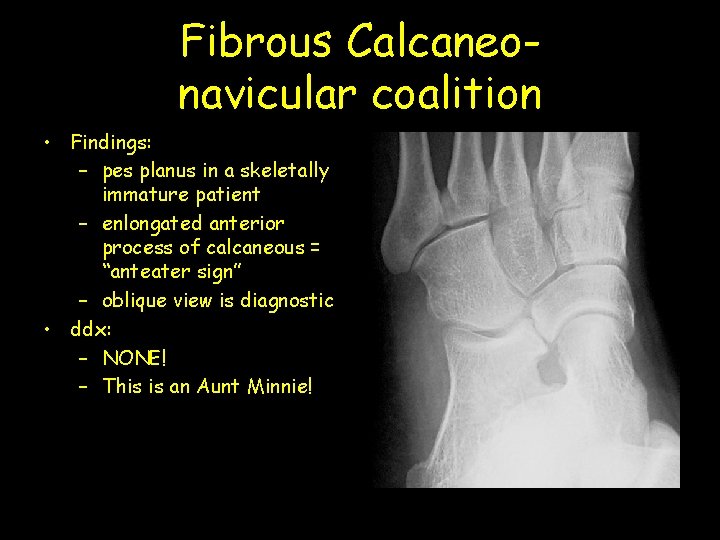 Fibrous Calcaneonavicular coalition • Findings: – pes planus in a skeletally immature patient –