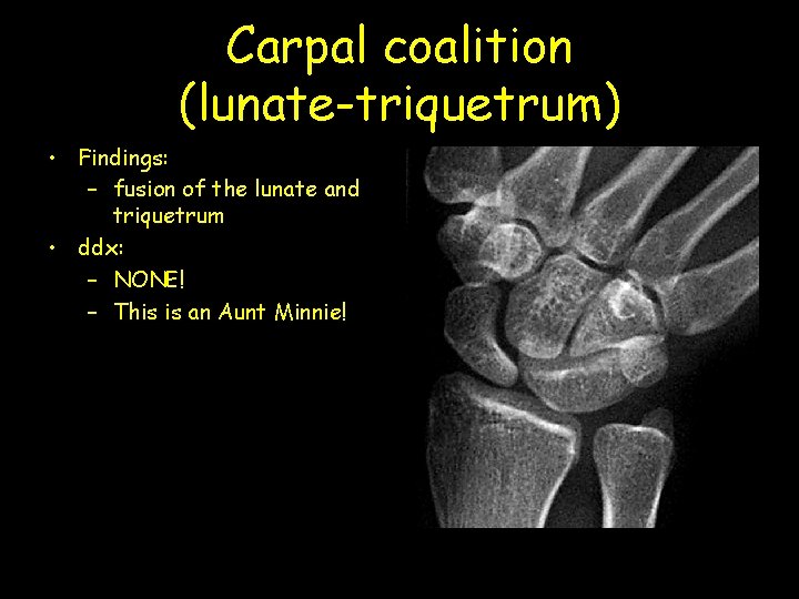 Carpal coalition (lunate-triquetrum) • Findings: – fusion of the lunate and triquetrum • ddx: