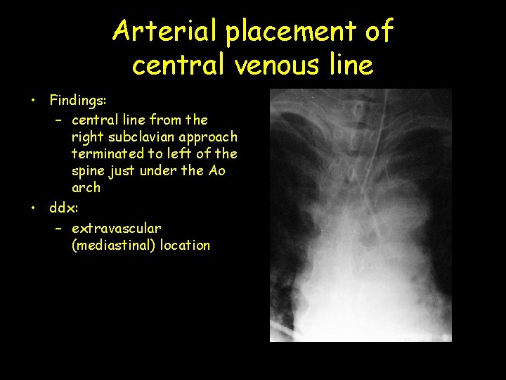 Arterial placement of central venous line • Findings: – central line from the right