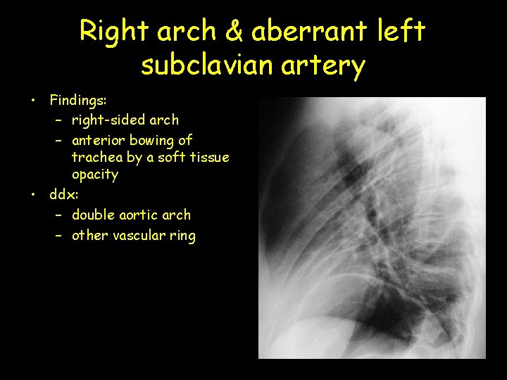 Right arch & aberrant left subclavian artery • Findings: – right-sided arch – anterior