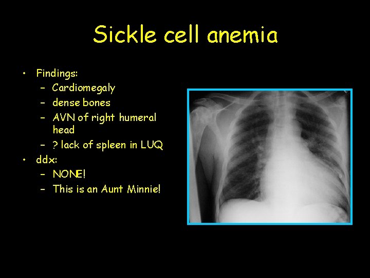 Sickle cell anemia • Findings: – Cardiomegaly – dense bones – AVN of right