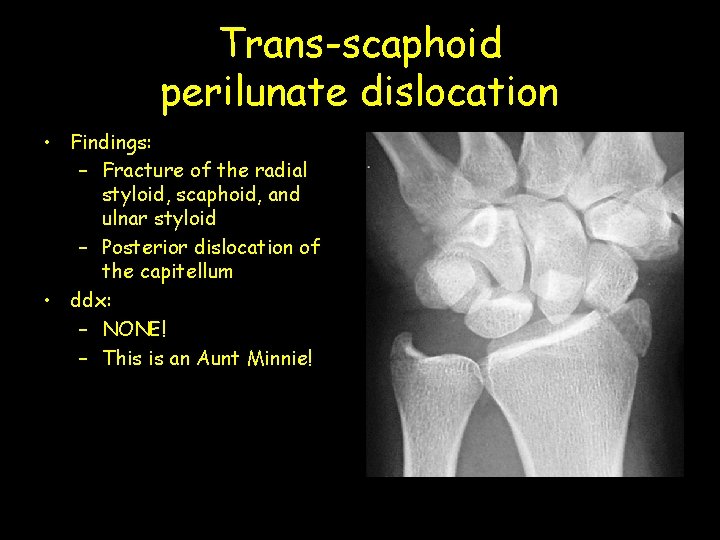 Trans-scaphoid perilunate dislocation • Findings: – Fracture of the radial styloid, scaphoid, and ulnar