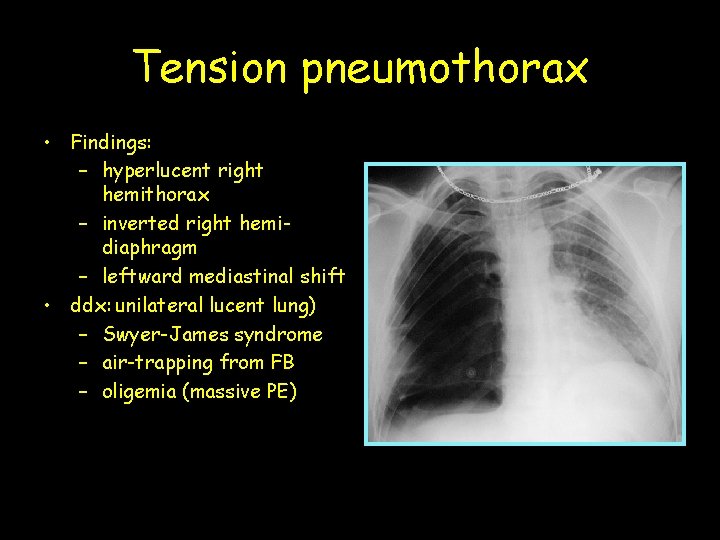 Tension pneumothorax • Findings: – hyperlucent right hemithorax – inverted right hemidiaphragm – leftward