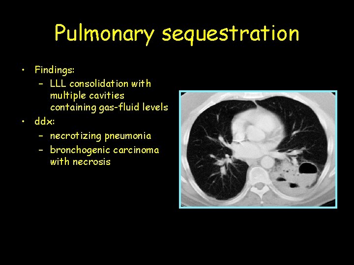 Pulmonary sequestration • Findings: – LLL consolidation with multiple cavities containing gas-fluid levels •