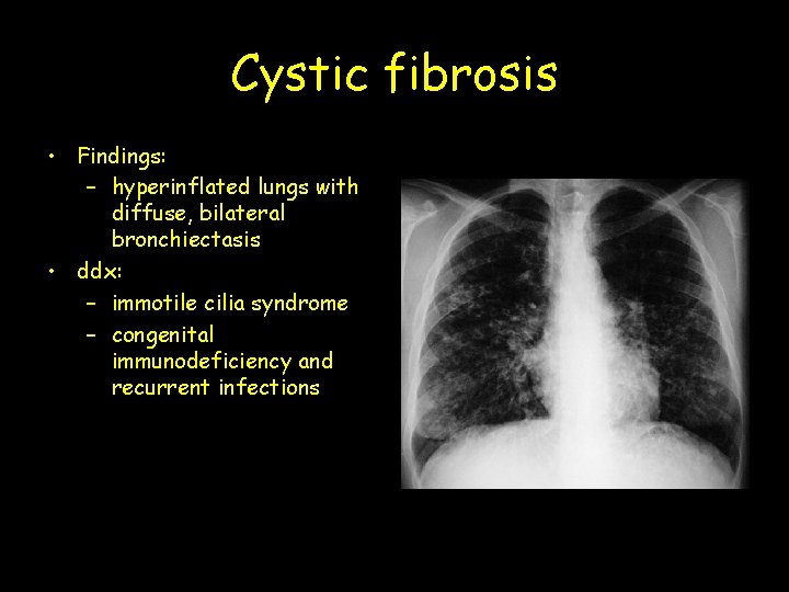 Cystic fibrosis • Findings: – hyperinflated lungs with diffuse, bilateral bronchiectasis • ddx: –