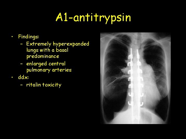 A 1 -antitrypsin • Findings: – Extremely hyperexpanded lungs with a basal predominance –