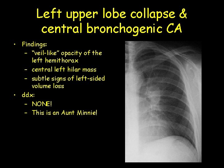 Left upper lobe collapse & central bronchogenic CA • Findings: – “veil-like” opacity of