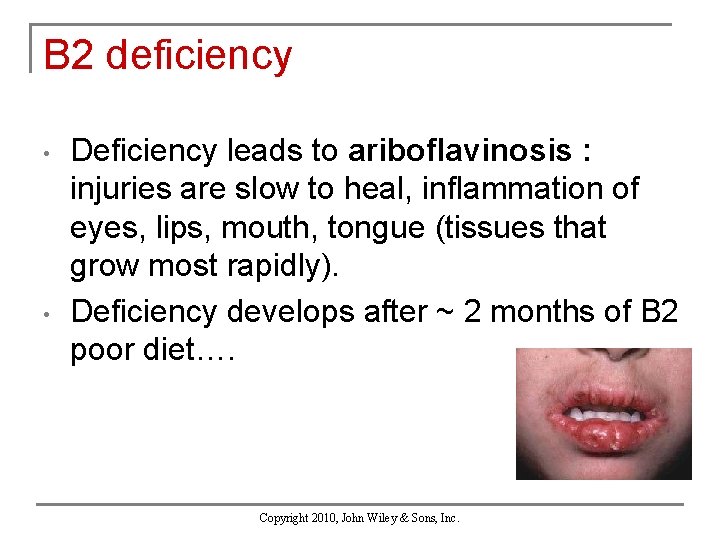 B 2 deficiency • • Deficiency leads to ariboflavinosis : injuries are slow to