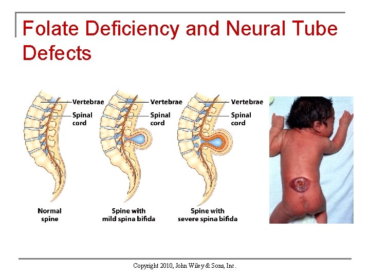 Folate Deficiency and Neural Tube Defects Copyright 2010, John Wiley & Sons, Inc. 