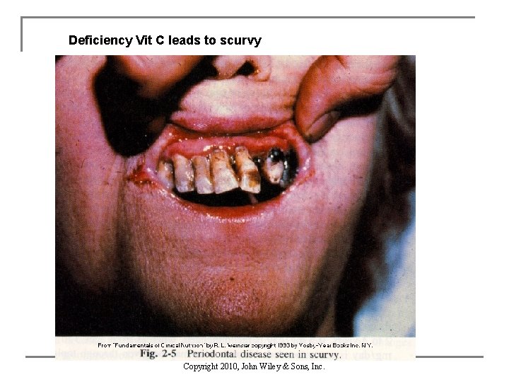 Deficiency Vit C leads to scurvy Copyright 2010, John Wiley & Sons, Inc. 