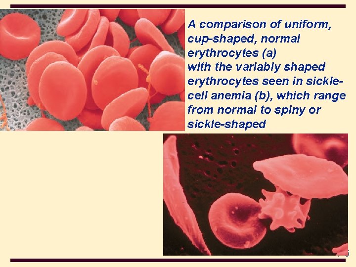 4 A comparison of uniform, cup-shaped, normal erythrocytes (a) with the variably shaped erythrocytes