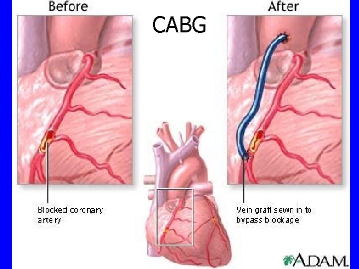 CABG 