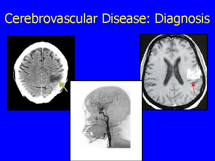 Cerebrovascular Disease: Diagnosis 