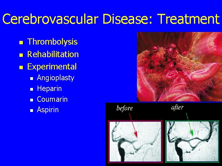 Cerebrovascular Disease: Treatment n n n Thrombolysis Rehabilitation Experimental n n Angioplasty Heparin Coumarin