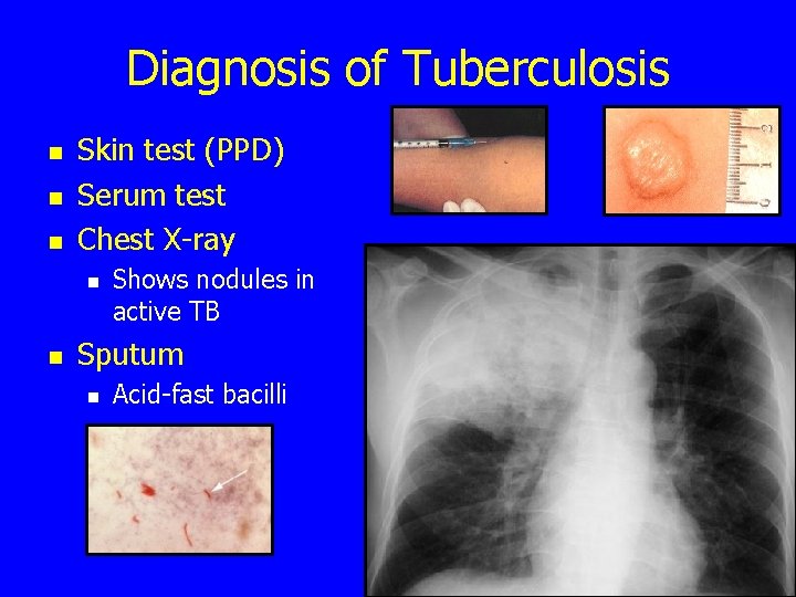 Diagnosis of Tuberculosis n n n Skin test (PPD) Serum test Chest X-ray n