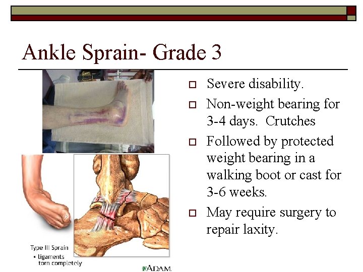 Ankle Sprain- Grade 3 o o Severe disability. Non-weight bearing for 3 -4 days.