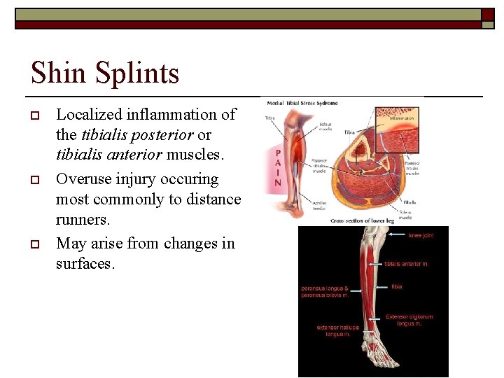 Shin Splints o o o Localized inflammation of the tibialis posterior or tibialis anterior