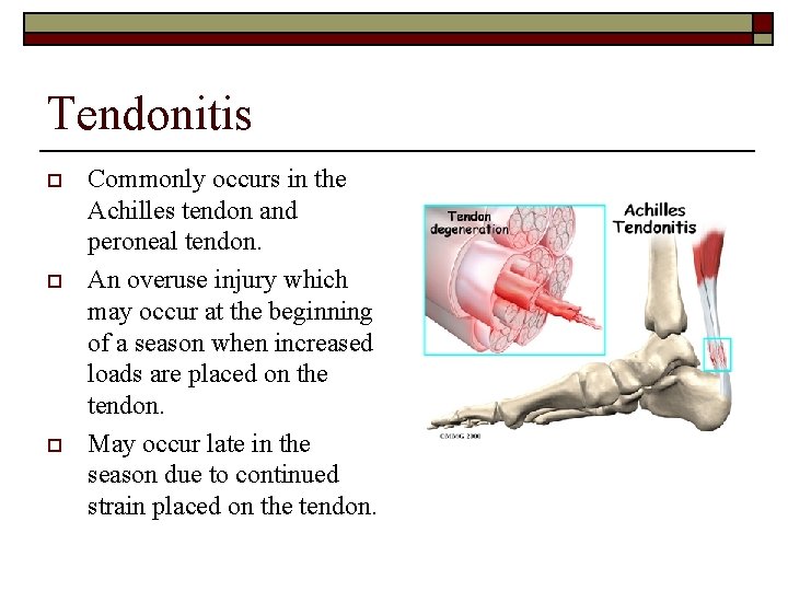 Tendonitis o o o Commonly occurs in the Achilles tendon and peroneal tendon. An