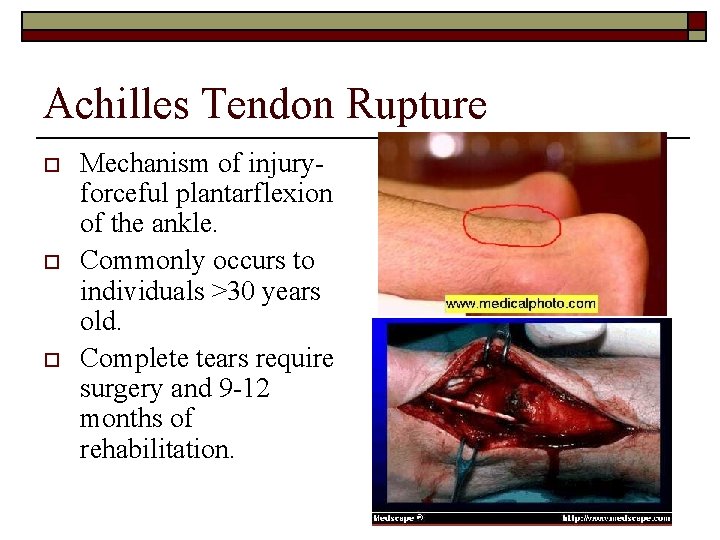 Achilles Tendon Rupture o o o Mechanism of injuryforceful plantarflexion of the ankle. Commonly